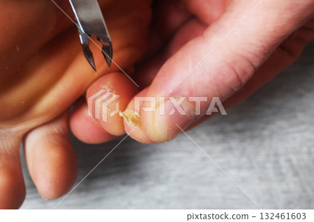 removal of corns from the toes. Medical Foot Care 132461603