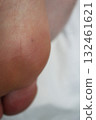 a black dot on the sole of the foot. Foot treatment close-up 132461621