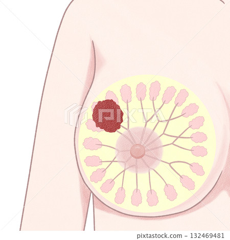 Breast Cancer Stage III (3rd Stage) Easy-to-understand illustrations Breast Cancer Stage III (3rd Stage) Easy-to-understand illustrations 132469481