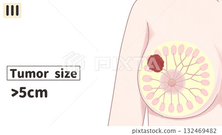 乳癌III期（第三期）簡單易懂的英文插圖 132469482