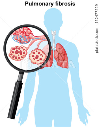 Magnified View of Pulmonary Fibrosis in Human Lungs 132477229