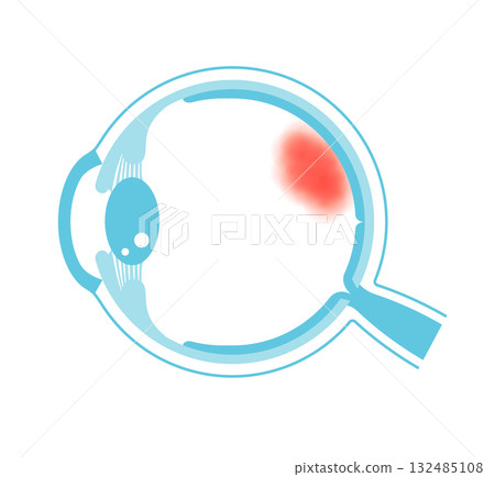 眼底出血向量圖解 眼底出血向量圖解 132485108