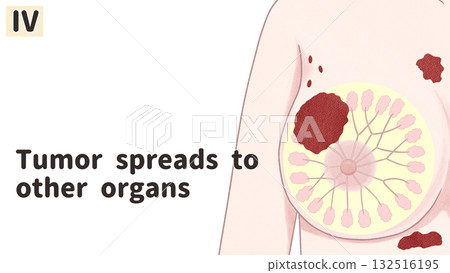 乳癌IV期(4期)簡單易懂的英文插圖 乳癌IV期(4期)簡單易懂的英文插圖 132516195