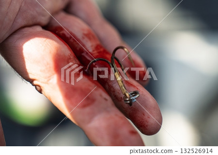 Fishing Hook Embedded in Hand A Cautionary Tale of Angling Mishaps and First Aid Needs Fishing Hook Embedded in Hand A Cautionary Tale of Angling Mishaps and First Aid Needs 132526914