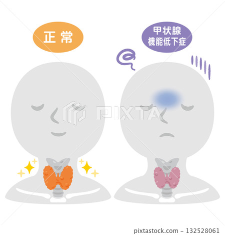 甲狀腺功能低下和甲狀腺功能正常的人的示意圖。 甲狀腺功能低下和甲狀腺功能正常的人的示意圖。 132528061