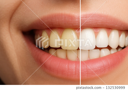 Veneer teeth whitening comparison shows bright smile transformation with natural and enhanced dental veneer effect for confident healthy appearance 132530999