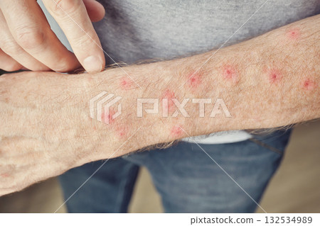 Caucasian mature male with skin rash and red spots on arm Caucasian mature male with skin rash and red spots on arm 132534989