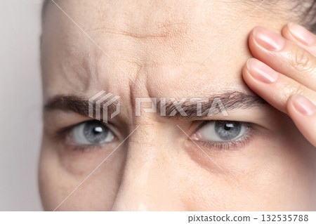 Portrait of Caucasian middle-aged woman pointing to the wrinkles on the upper eyelid forehead and bridge of nose. Signs of aging on the face close up 132535788