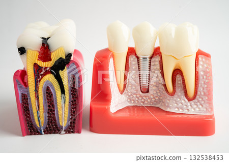Dental implant, artificial tooth roots into jaw, root canal of dental treatment, gum disease, teeth model for dentist studying about dentistry. Dental implant, artificial tooth roots into jaw, root canal of dental treatment, gum disease, teeth model for dentist studying about dentistry. 132538453