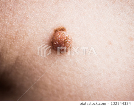 dark fibroma, dermatology problem on skin. Close up of papilloma dermatosis 132544324