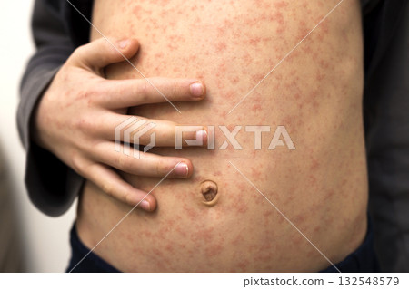 Sick child body, stomach with red rush spots from measles or chicken pox. Contagious child diseases and treatment. Sick child body, stomach with red rush spots from measles or chicken pox. Contagious child diseases and treatment. 132548579