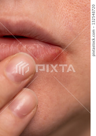 Close-up View of Lip Herpes Virus Lesion on the Skin With Potential Treatment Methods 132548720