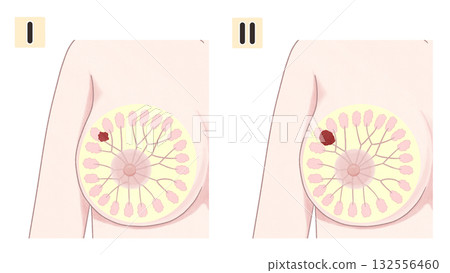 乳癌I期和II期圖解－簡單易懂的插圖 132556460