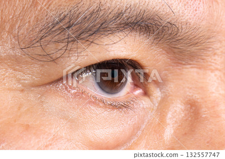 Senior man has cataract. Generally, cataracts are common in older people. Senior man has cataract. Generally, cataracts are common in older people. 132557747