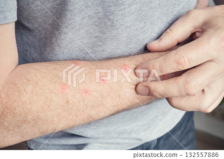 Caucasian male examining red bumps on forearm skin rash 132557886