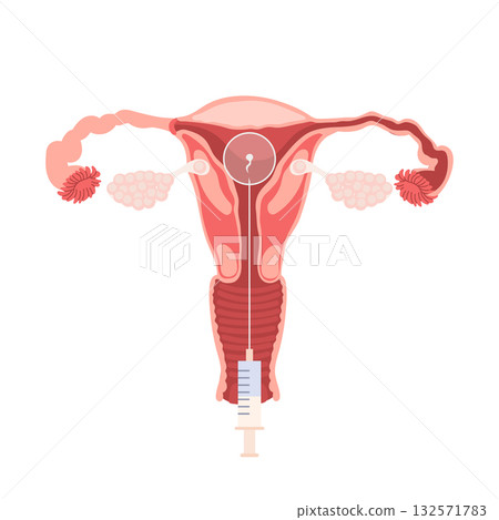 Female uterus. Female Reproductive System. In Vitro Fertilization (IVF) Medical Procedure. Medical education diagram for use in infographics on gynecology. 132571783