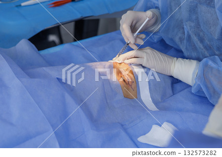 Gloved surgeon injects local anesthesia into a marked eyelid before blepharoplasty under sterile drapes in a modern clinic 132573282