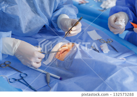 Gloved surgeons suture a marked eyelid during blepharoplasty under sterile drapes using microinstruments in a modern clinic 132573288