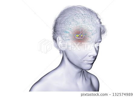 Human brain with degenerated substantia nigra in Parkinson's disease, 3D illustration Human brain with degenerated substantia nigra in Parkinson's disease, 3D illustration 132574989