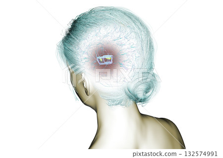 Human brain with degenerated substantia nigra in Parkinson's disease, 3D illustration Human brain with degenerated substantia nigra in Parkinson's disease, 3D illustration 132574991