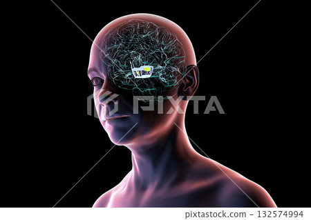 Human brain with degenerated substantia nigra in Parkinson's disease, 3D illustration Human brain with degenerated substantia nigra in Parkinson's disease, 3D illustration 132574994