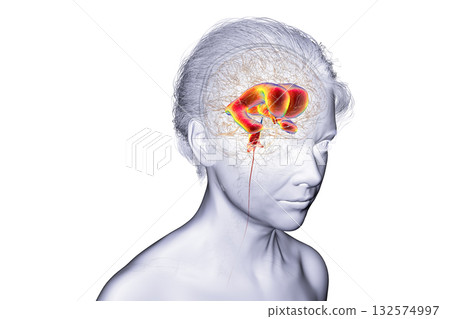 Normal pressure hydrocephalus, 3D illustration 132574997