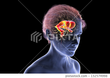 Normal pressure hydrocephalus, 3D illustration 132574998