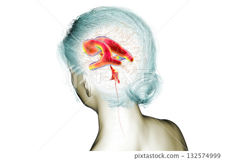 Normal pressure hydrocephalus, 3D illustration 132574999