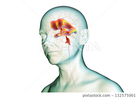 Normal pressure hydrocephalus, 3D illustration 132575001