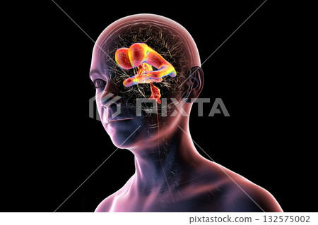 Normal pressure hydrocephalus, 3D illustration 132575002