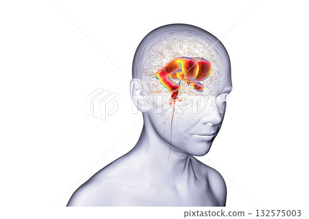 Normal pressure hydrocephalus, 3D illustration 132575003