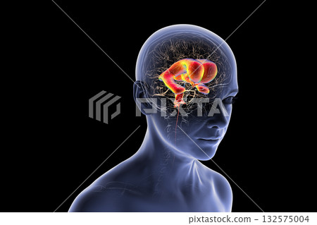 Normal pressure hydrocephalus, 3D illustration 132575004
