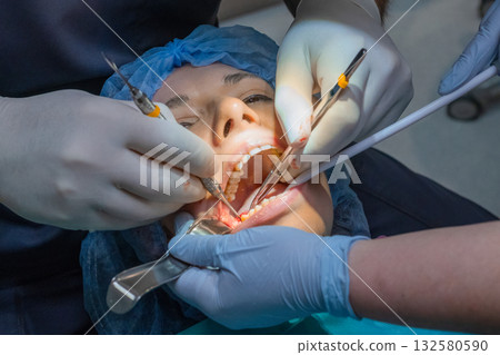 Doctor works on patient widely open mouth using suction tool during procedure. Woman jaw fixed stable allowing clear access for dental treatment. High quality photo 132580590