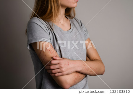 Person showing arm rash from pain 132583810