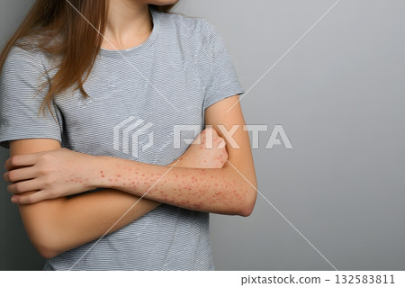 Skin with red spots showing discomfort and pain. 132583811