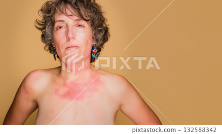 Woman embracing unique beauty despite immune deficiency skin condition Woman embracing unique beauty despite immune deficiency skin condition 132588342