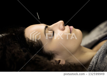 特寫鏡頭展現一位女士接受美容針灸治療。畫面輕鬆，展現了透過按壓臉部穴位和針灸療法改善皮膚狀況的過程。 132599949