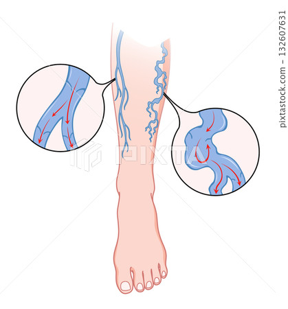 Varicose veins. Blue blood vessel visible through the skin, abnormally swollen leg. Vascular disease diagnostic and treatment. Venous insufficiency medical disease Varicose veins. Blue blood vessel visible through the skin, abnormally swollen leg. Vascular disease diagnostic and treatment. Venous insufficiency medical disease 132607631