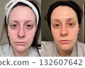 Before and after improvement of dull skin and rough skin. A woman who uses skin care to treat redness and dark circles. 132607642