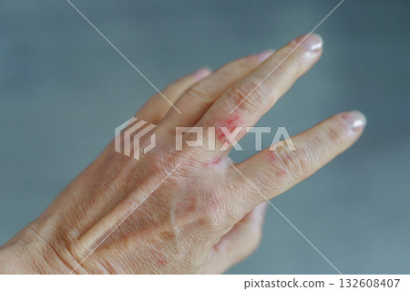 woman hand with scratched finger, wound 132608407