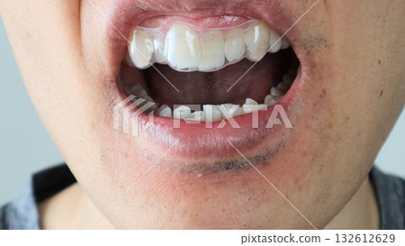 特寫鏡頭：一個人的牙齒上戴著牙套 132612629