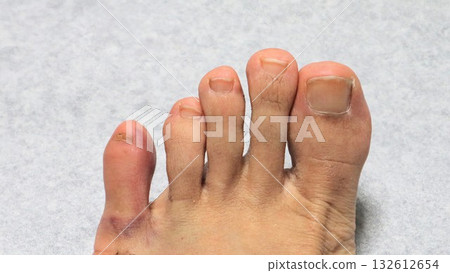 A Japanese man's injured, swollen leg 132612654