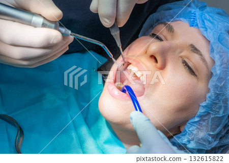 Dental team performs oral surgical procedure on female patient. Professional uses mouth prop to keep woman jaw open for clear access to teeth. High quality photo 132615822