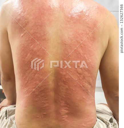 Young asian man itching and scratching on his back from allergic itchy dry skin eczema dermatitis insect bites 132627366