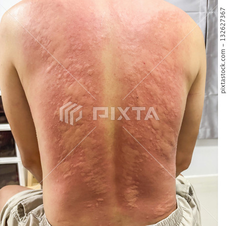 Young asian man itching and scratching on his back from allergic itchy dry skin eczema dermatitis insect bites 132627367