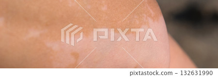Skin with vitiligo. Female legs and arms with autoimmune disease. pigmentation 132631990