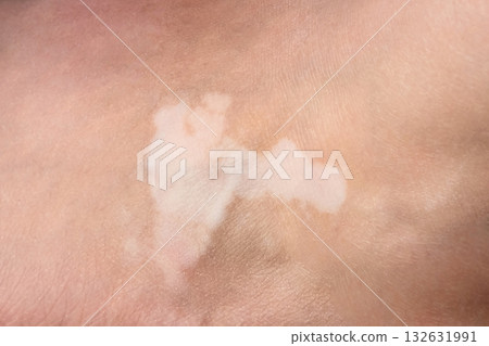 Skin with vitiligo. Female legs and arms with autoimmune disease. pigmentation 132631991