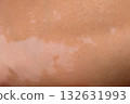 Skin with vitiligo. Female legs and arms with autoimmune disease. depigmentation 132631993