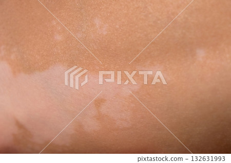 Skin with vitiligo. Female legs and arms with autoimmune disease. depigmentation 132631993