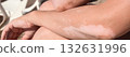 Skin with vitiligo. Female legs and arms with autoimmune disease. pigmentation 132631996